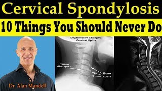 CERVICAL SPONDYLOSIS 10 Things You Should Never Do  Dr Alan Mandell DC [upl. by Nirok]