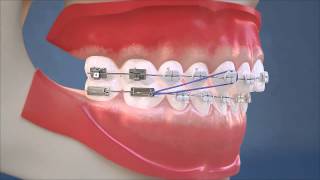 Class II Elastics  Lateral View HD Edition [upl. by Flann]