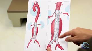 What is an aneurysm [upl. by Tonnie]