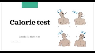 Caloric test Essential medicine [upl. by Stranger]