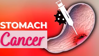 Stomach Cancer Causes Signs and Symptoms Diagnosis and Treatment [upl. by Tserof549]