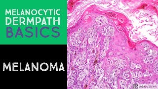 Melanocytic Dermpath Basics Melanoma [upl. by Haseefan]