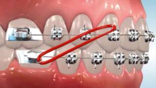 Class 2 Elastics  Easton Ortho 101 with Dr Loftus [upl. by Arved]