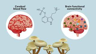 Psilocybin may ‘reset’ the brain to help manage treatmentresistant depression [upl. by Adialeda]