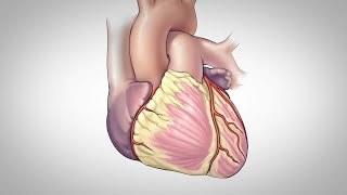 Intracranial Aneurysm Causes [upl. by Yojal]