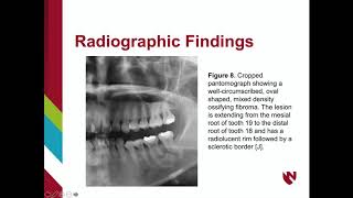 Ossifying Fibroma [upl. by Leavy]