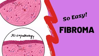 Fibroma  ORAL PATHOLOGY [upl. by Enael]