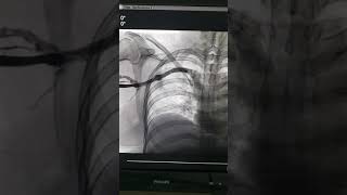 Colocación de un stent venoso [upl. by Ytak]