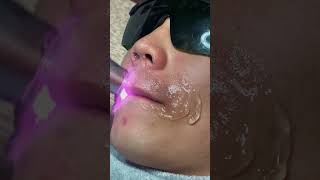 Diode Laser Hair Removal Permanent [upl. by Liddy953]