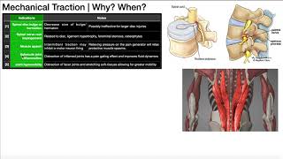 Mechanical Traction Part 1  Theory Indications amp Contraindications [upl. by Blum]