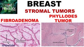 Oral Pathology  Connective Tissue Benign Tumors  INBDE ADAT [upl. by Alesiram240]