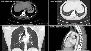 Introduction to Computed Tomographic imaging of the Chest [upl. by Sirron]