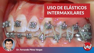 Uso de Elásticos Intermaxilares [upl. by Connors]