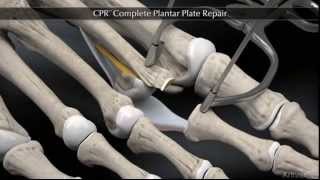 Plantar Plate Repair [upl. by Sethrida]