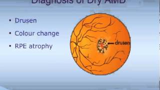 Dry AgeRelated Macular Degeneration Dry AMD [upl. by Aisatana]