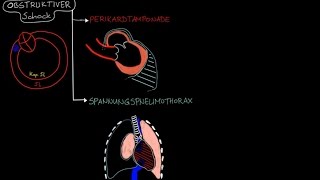 KREISLAUFSCHOCK 57 – OBSTRUKTIVER SCHOCK Vorschau [upl. by Alleyn367]