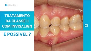 TRATAMENTO DA CLASSE II COM INVISALIGN Aprenda a planejar com attachments e elásticos de Classe II [upl. by Brittnee]