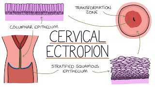 Understanding Cervical Ectropion  Cervical Erosion [upl. by Eseeryt]