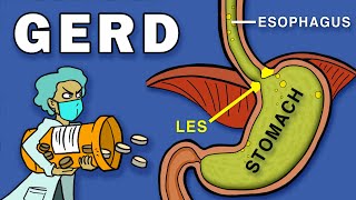 Gastroesophageal Reflux Disease GERD [upl. by Hogle202]