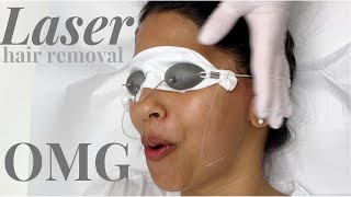 I did LASER HAIR REMOVAL all over my FACE [upl. by Fredericka]