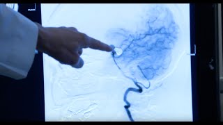 Endovascular Coiling for Brain Aneurysm Animation [upl. by Nnylsor]