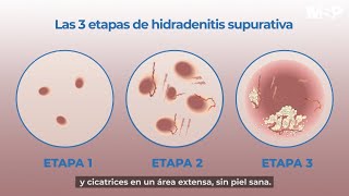 Hidradenitis Supurativa [upl. by Larry]