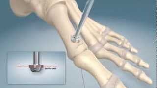 1st MTPJ arthrodesis procedure [upl. by Ettenot]