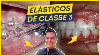 7 CUIDADOS AO USAR OS ELÁSTICOS DE CLASSE 3 [upl. by Selimah]