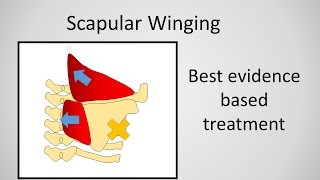 Scapular Winging Causes and Treatment [upl. by Kirit]