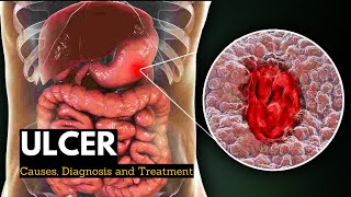 Ulcer Causes Signs and Symptoms Diagnosis and Treatment [upl. by Calhoun195]