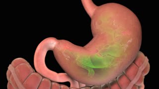 Stomach Ulcer  Nucleus Health [upl. by Atilamrac]