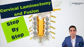 Posterior Cervical Laminectomy and Fusion  Procedure details recovery and expectations [upl. by Lienahs433]