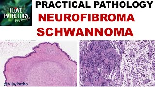 Schwannoma 5Minute Pathology Pearls [upl. by Naimaj]