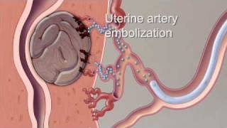 Painful Plantar Fibromas in Feet [upl. by Bogoch75]