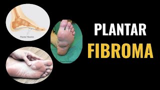 Plantar Fibroma [upl. by Tuorah847]