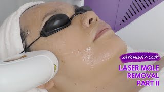 Laser Hair Removal Diode Laser Hair Removal 808nm Laser Painless myChway GX002 Part II Face [upl. by Muhan401]