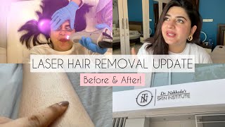 Full Body Laser Hair Removal Update  Does it Make a Difference GlossipsVlogs [upl. by Berthold]