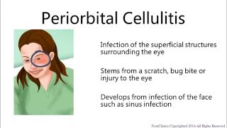 Periorbital Cellulitis Emergency [upl. by Kerge547]