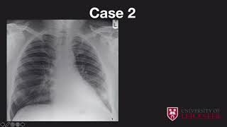 Chest xray case review [upl. by Galligan]