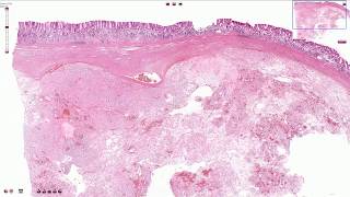 Gastrointestinal Stromal Tumor GIST  Histopathology [upl. by Rapsac]