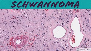 Oral Pathology  Odontogenic Tumors  INBDE ADAT [upl. by Nellir]